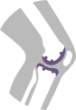 Liečba bolesti kolena - osteoartróza